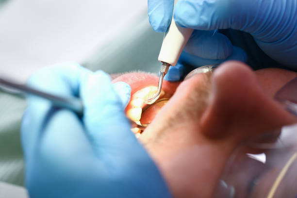 Best Emergency Wisdom Teeth Removal in Salisbury, NC