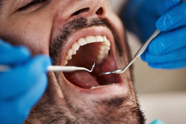 Best Emergency Tooth Extraction in Salisbury, NC